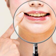 都筑区(都筑ふれあいの丘駅)の歯医者、マサキ歯科クリニックで、ホワイトニングしても歯が白くならない原因を解説