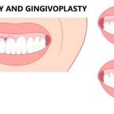 都筑区(都筑ふれあいの丘駅)の歯医者、マサキ歯科クリニックで、歯冠長延長術を解説