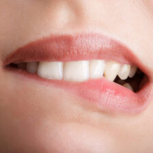 都筑区(都筑ふれあいの丘駅)の歯医者、マサキ歯科クリニックで、唇を噛む癖「咬唇癖」が引き起こす歯並びへの影響と対処法を解説